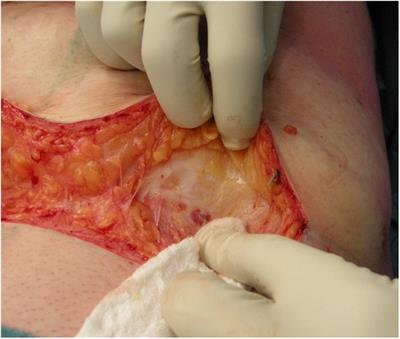 Abdominoplasty after massive weight loss. Safety preservation fascia technique and clinical outcomes in a large single series-comparative study